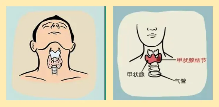 1666144948710870.jpg 杭州中医治疗结节:甲状腺结节的早期症状